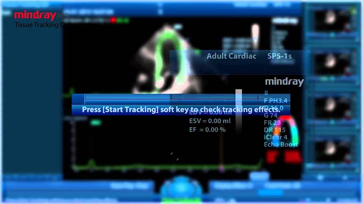 Tissue Tracking Quantitative on Mindray M9 with Dr  Leopoldo Pérez de Isla