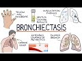 Understanding Bronchiectasis