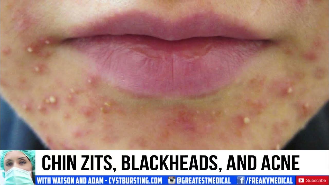 Why Am I Getting Zits On My Legs