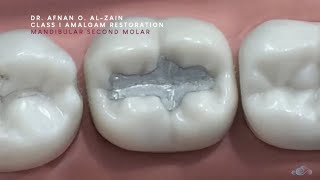 Class I amalgam restoration – Mandibular molar (#47) - Arabic عربي
