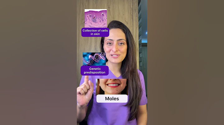Moles | What are they | How to treat| dermatologist explains