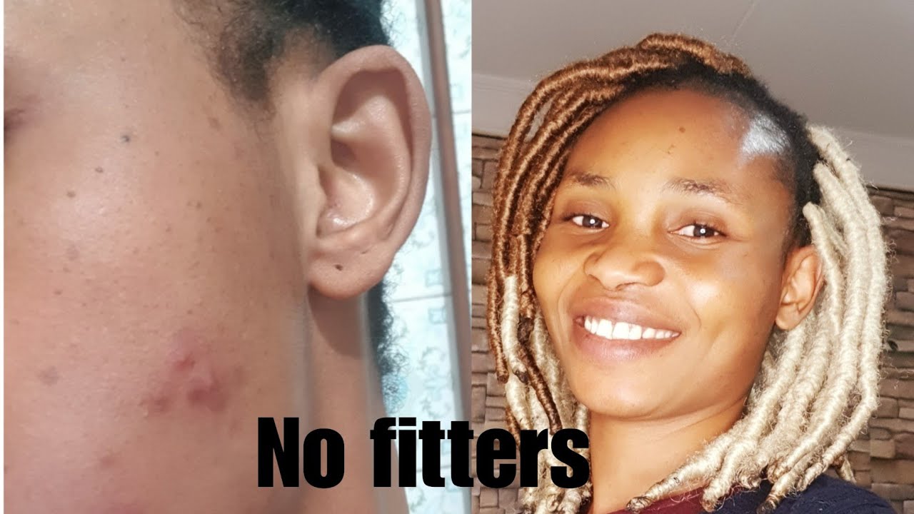 HOW TO GET RID OF SPOT FAST YouTube