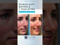 Rhinoplasty Results After 1 Year 👃🤩 | Dr. Becker