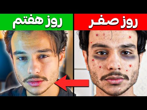 اینطوری در 7 روز جوشات رو کامل از بین ببر (تضمینی)
