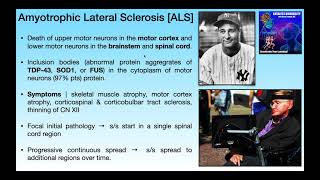 Celebrity Amyotrophic Lateral Sclerosis [ALS] | Basics & Clinical Presentation Wealth