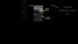 Subcutaneous Air on #POCUS #FOAMed #FOAMus