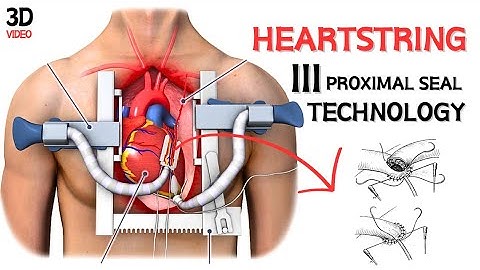 The Heartstring III proximal seal technology - Animation #cardiology