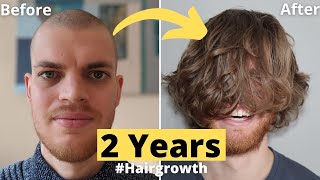 Hair Growth Time Lapse 2 Years (24 Months) Men  From Buzz Cut