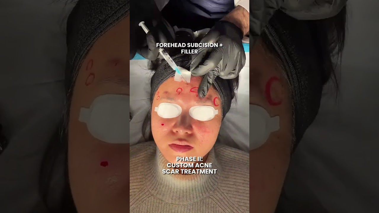 Custom Acne Scar Treatment