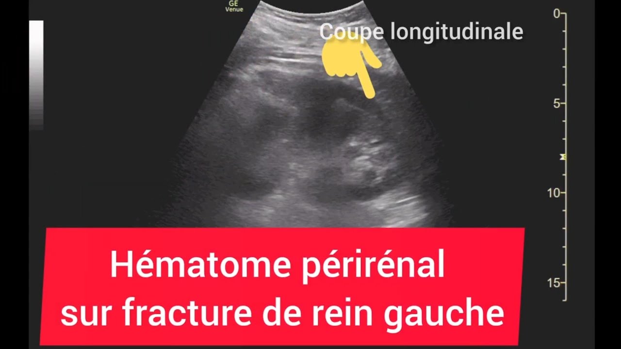 Hématome périrénal sur Fracture de Rein Trauma Grade 3 AAST Échographie