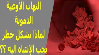 إلتهاب الأوعية الدموية | الأسباب | الأعراض | العلاج