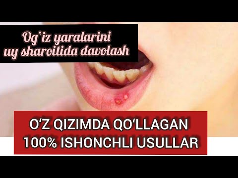 Video: Kichkintoyda Stomatitni Qanday Davolash Mumkin