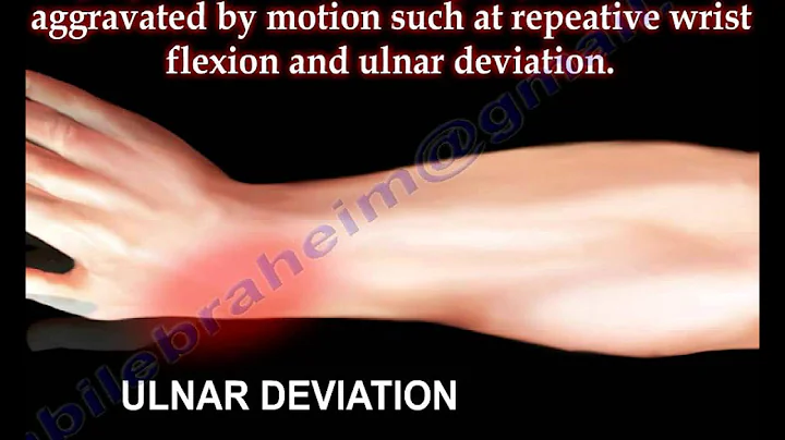 Entrapment of Radial Nerve, Wartenberg's Syndrome - Everything You Need To Know - Dr. Nabil Ebraheim - DayDayNews