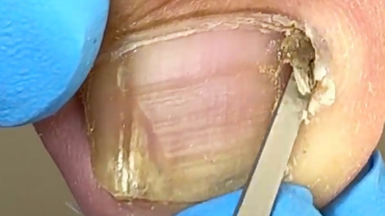 Pedicure Tutorial The Complete Ingrown Toenail Repair Process! YouTube