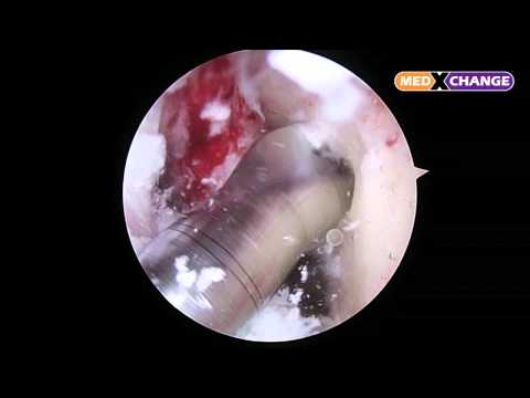Arthroscopy 2 Surgery - Med X Change