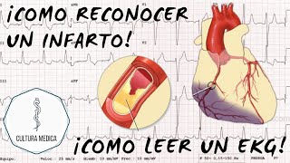 COMO RECONOCER UN INFARTO EN EL EKG/ECG| EKG PARTE 7|