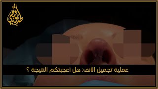 عمليات #تجميل_الأنف | الدكتور #طارق_قبطي طبيب تجميل