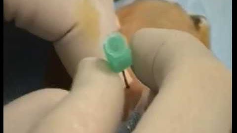 Transradial Access - Video 5.1