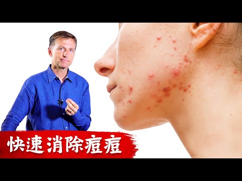 快速消除痘痘?痘痘自然療法.柏格醫生 Dr berg