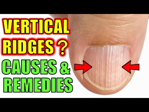 Ridges In Nails: Everything You Should Know and How to Deal with Them