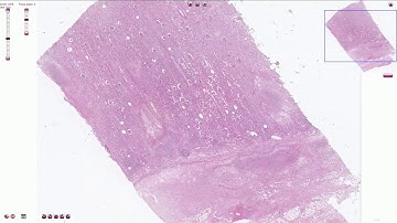 Acute Pyelonephritis - Histopathology