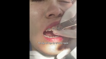 Bọc Răng Sứ: Răng Khấp Khểnh nên Niềng trước đã rồi hãy Làm Răng Sứ #rangsu #rangsuthammy