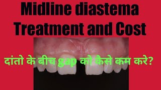 Midline Diastema Treatment and Cost/ दांतो के बीच gap को कैसे कम करे?
