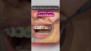 تخدير موضعي ل الأسنان | Local infiltration #yearofyou