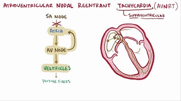Atrioventricular reentrant tachycardia AVRT & nodal reentrant tachycardia AVNRT