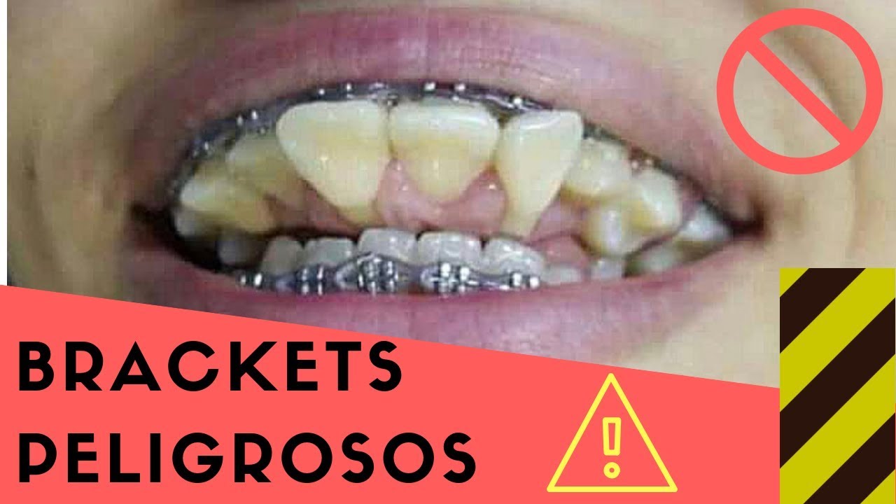 Donde puedo ponerme brackets baratos