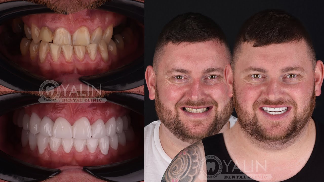 ZIRCONIUM CROWNS DENTAL TREATMENT | TURKEY DENTAL CLINIC | ANTALYA DENTAL CLINIC | HOLLYWOOD SMILE..