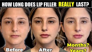 How Long does Lip Filler Last? How Often Should You get Your Lips Redone? by Natural Injector - Emily Dowe, PA-C 26,474 views 1 year ago 12 minutes, 6 seconds