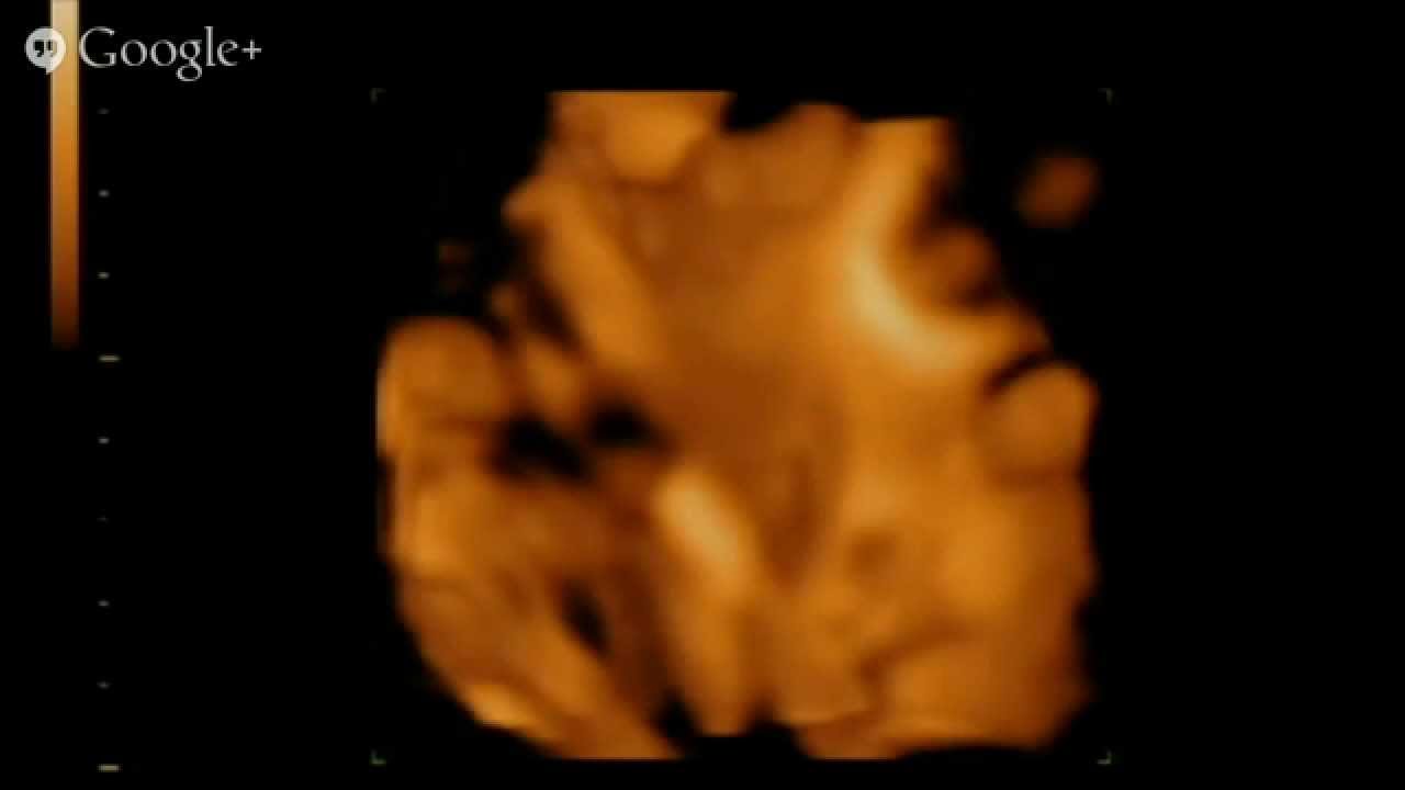 3D Ultrasound and 4D Ultrasounds in Orlando - YouTube