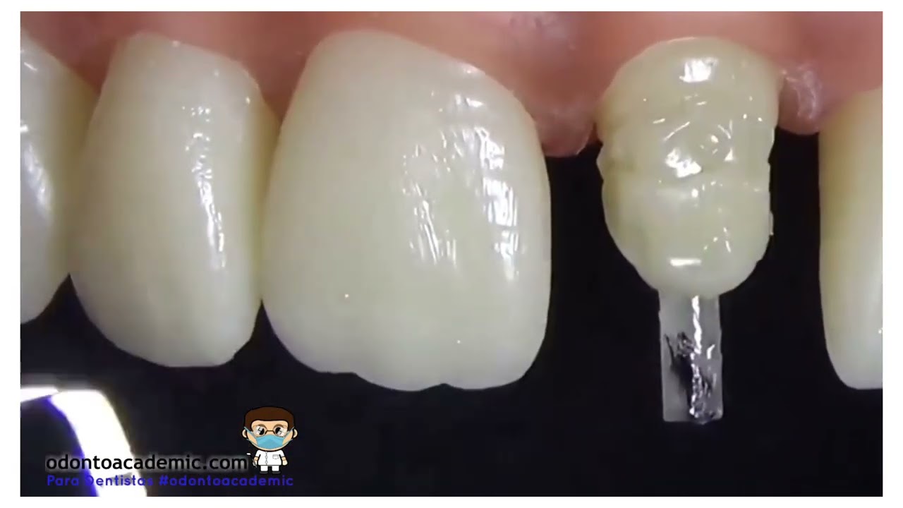 Colocación de poste dental de fibra de vidrio . ODONTOACADEMIC YouTube