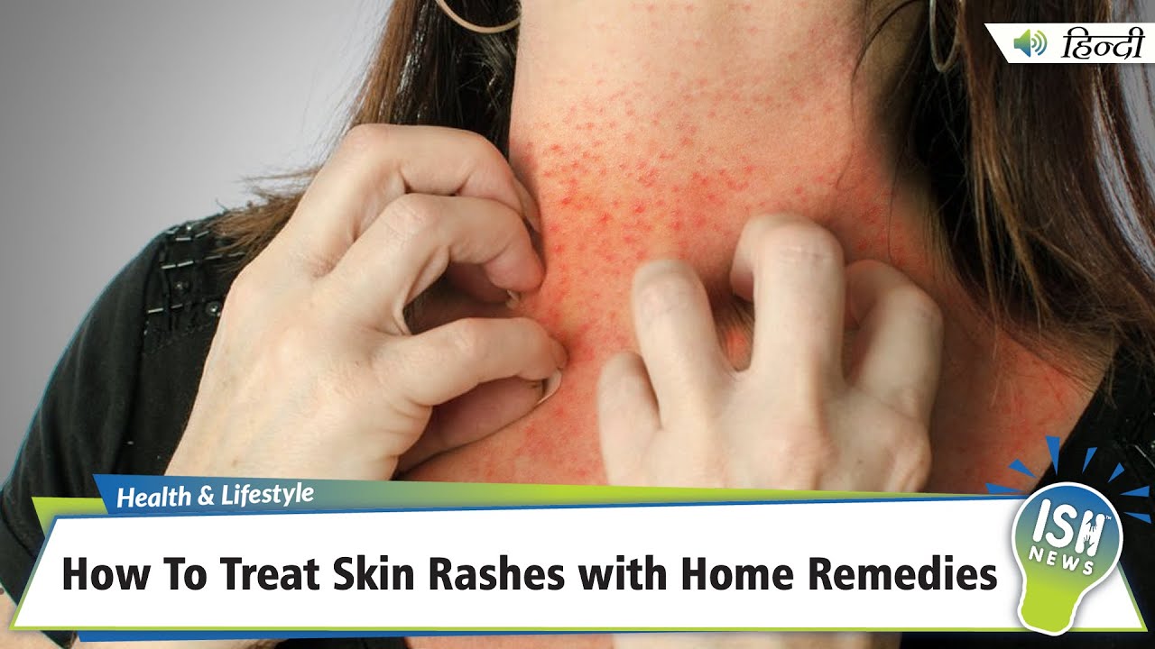 22 Home Remedies To Get Rid Of Rashes On The Face + Diet And Prevention Tips