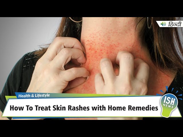 Heat Rash in Adults Treatments