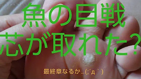 تحميل 魚の目芯引っこ抜く