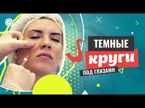♥♥ Как убрать ТЕМНЫЕ КРУГИ под глазами?! ♥♥ Коррекция филлерами ♥