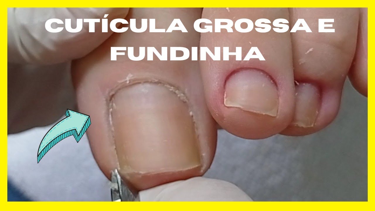 Veja como tirar cutícula grossa e fundinha sem machucar os cantinhos.