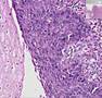 Histopathology Esophagus--Squamous cell carcinoma