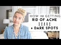 How Im Getting Rid of Acne Scars + Dark Spots
