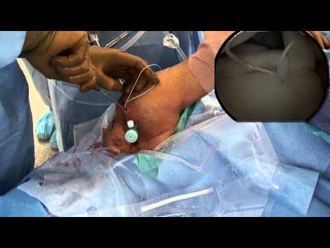 Shoulder Arthroscopy: SLAP Repair by Scott Trenhaile, MD