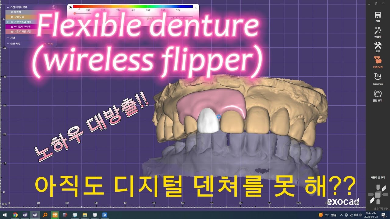 Exo cad를 이용한 Flexible denture(wireless flipper)digtal denture를 아직도 못해?