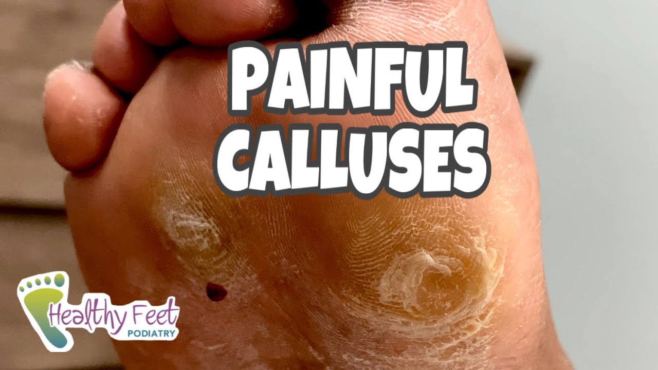 CALLUS REMOVAL AT HOME! SO SATISFYING! 