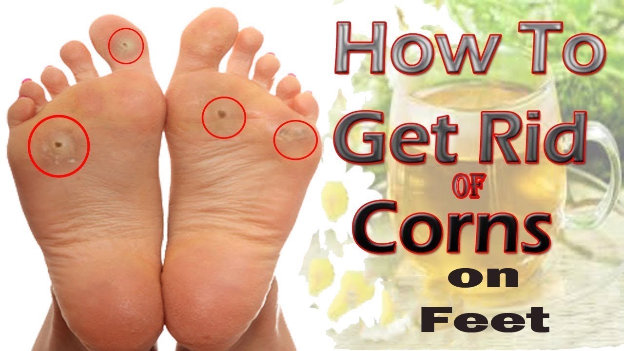 How To Get Rid Of Corns On Feet Naturally At Home Home Remedies For