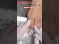 巻き爪ケアフレックスプレートで巻き爪矯正