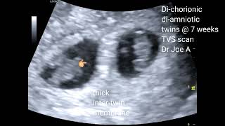 Di-amniotic di-chorionic twin pregnancy: chorionicity of twins: transvaginal ultrasound video