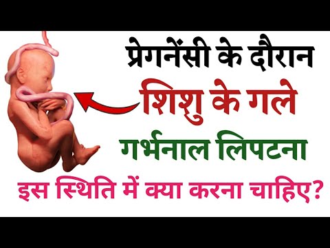 वीडियो: अगर गर्भनाल बच्चे के गले में लिपटी हो तो क्या करें?