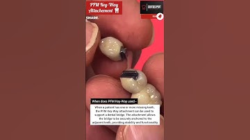 Dental Bridge Procedure | Fixed Key-Way Dental Bridge 💯 #shorts #dentist #viral 🔥