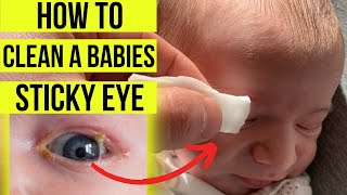 How to treat a STICKY EYE in babies (including eye-lid hygiene cleaning & tear duct massage) screenshot 5